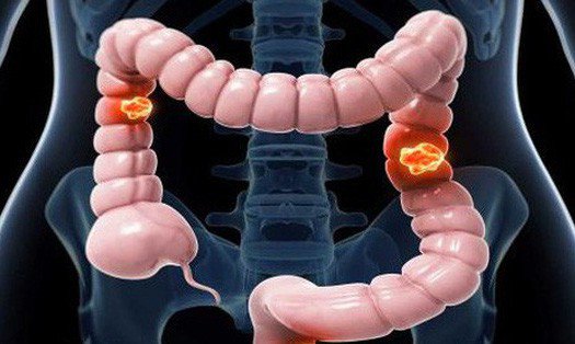 Ung thư có được uống sữa