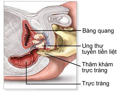 Ung thư có được uống sữa