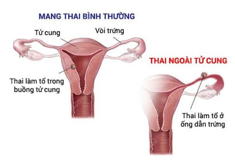 Thai ngoài tử cung mấy tuần thì vỡ?