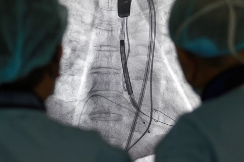 Replacement of the heart valve without surgery safe approach, quick