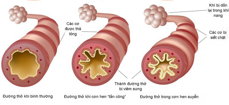Trẻ hen phế quản nên hạn chế ăn gì?