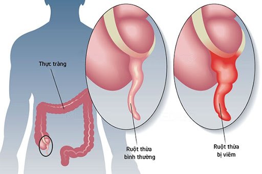 ruột thừa đau bên nào