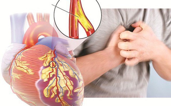 Suy tim - Đích đến cuối cùng của các bệnh tim mạch và một số bệnh khác Suy tim - Đích đến cuối cùng của các bệnh tim mạch và một số bệnh khác
