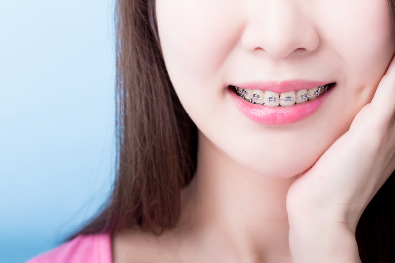Gói chỉnh nha mắc cài thế hệ mới 2