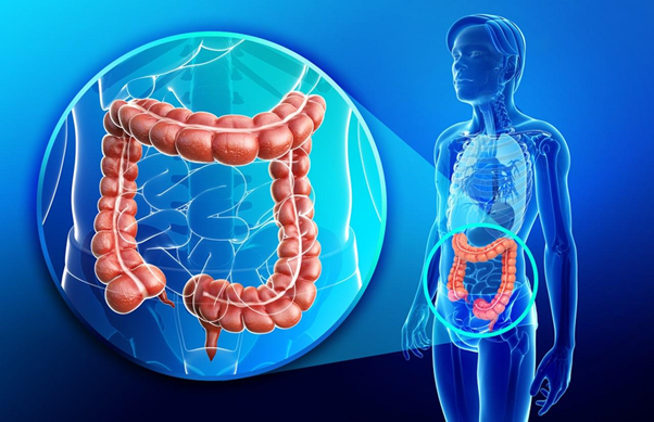 Ung thư đại tràng giai đoạn 2 có chữa được không?