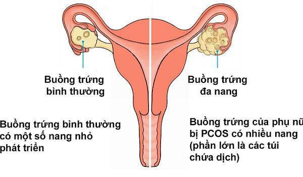 Buồng trứng đa nang có con được không?
