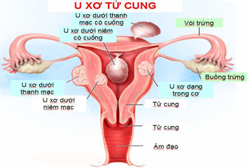 u xơ tử cung