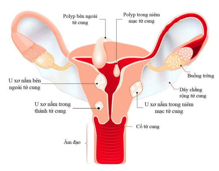 Kết quả hình ảnh cho Nguyên nhân gây u xơ cổ tử cung"