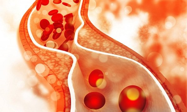 LDL cholesterol trong máu