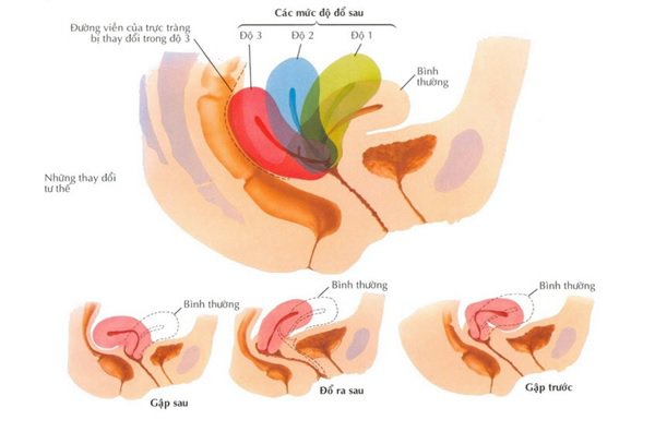 Các phương pháp điều trị sa sinh dục Các phương pháp điều trị sa sinh dục