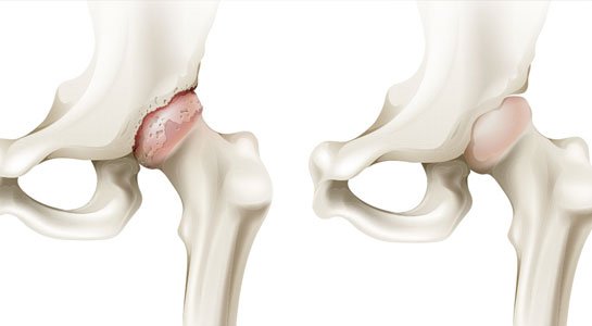 Hoại tử chỏm xương đùi