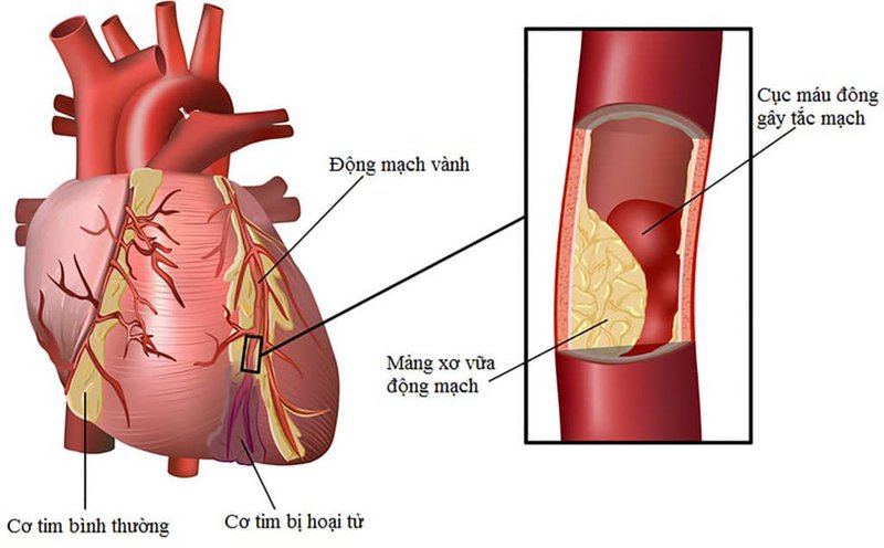 Tìm hiểu về bệnh động mạch vành