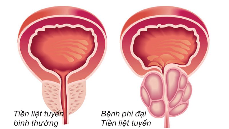 Chẩn đoán và điều trị phì đại tuyến tiền liệt lành tính 20190507_033731_732845_phi_dai_tuyen_tien_li.max-800x800