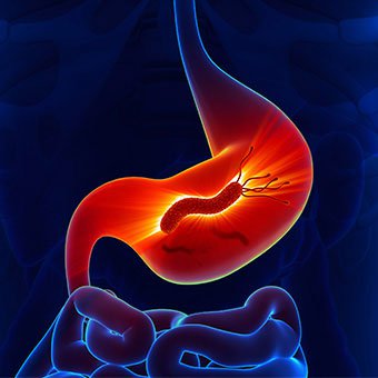 Phác đồ điều trị viêm loét dạ dày tá tràng ở trẻ em Phác đồ điều trị viêm loét dạ dày tá tràng ở trẻ em