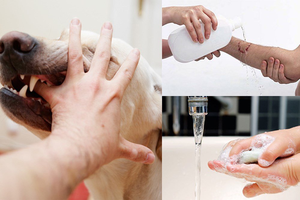 Bệnh dại ở người