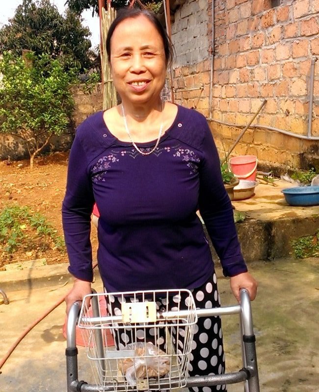 Hồi phục kỳ diệu cho bệnh nhân 8 năm không đi được vì mổ thay khớp háng thất bại