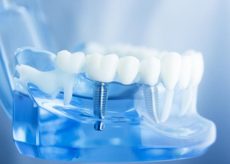 Phẫu thuật cấy ghép Implant: Giải pháp tối ưu cho người bị mất răng lâu năm