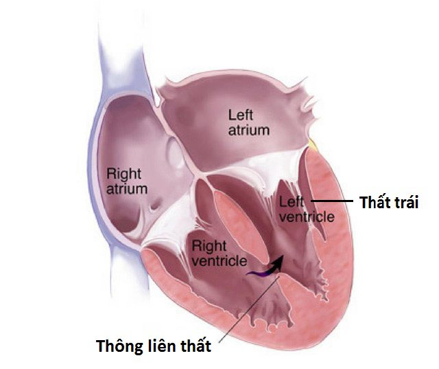 Thông liên thất