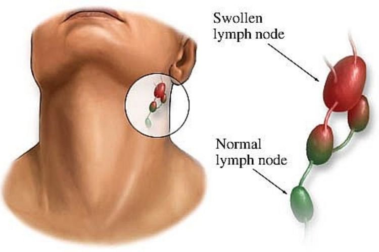 lymphadenopathy hiv