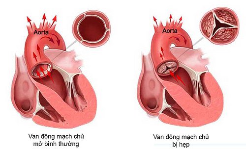 Các biện pháp điều trị bệnh hẹp van động mạch chủ