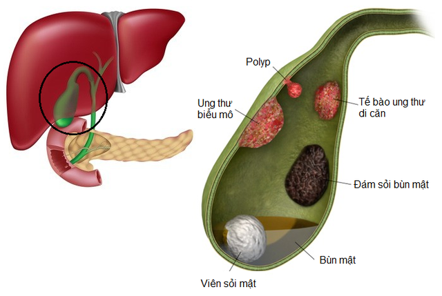 Làm thế nào để chẩn đoán và điều trị polyp túi mật?