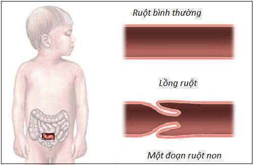 Các bệnh nghiêm trọng trẻ có thể mắc trong giai đoạn 0-3 tuổi Các bệnh nghiêm trọng trẻ có thể mắc trong giai đoạn 0-3 tuổi