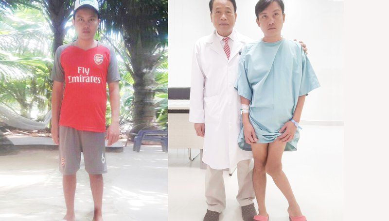 Phẫu thuật mổ chân khèo cho bệnh nhân Phú Quốc