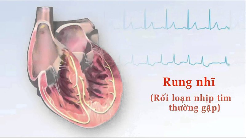 Ai dễ mắc rung nhĩ?