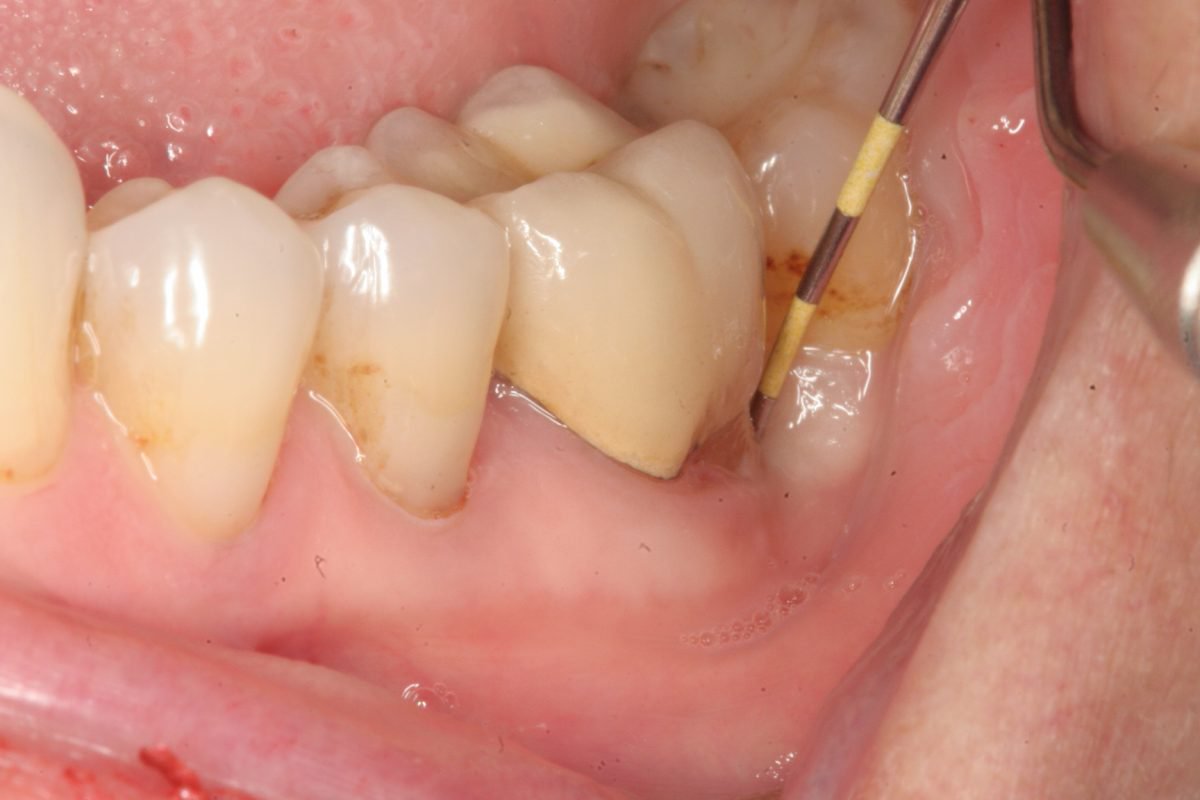 Sâu răng gây nên bệnh viêm quanh cuống răng