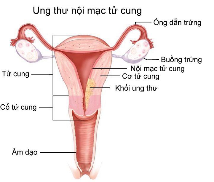 Ung thư nội mạc tử cung Những điều cần biết Vinmec