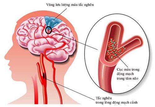 Chóng mặt trung ương và ngoại biên: Những điều cần biết