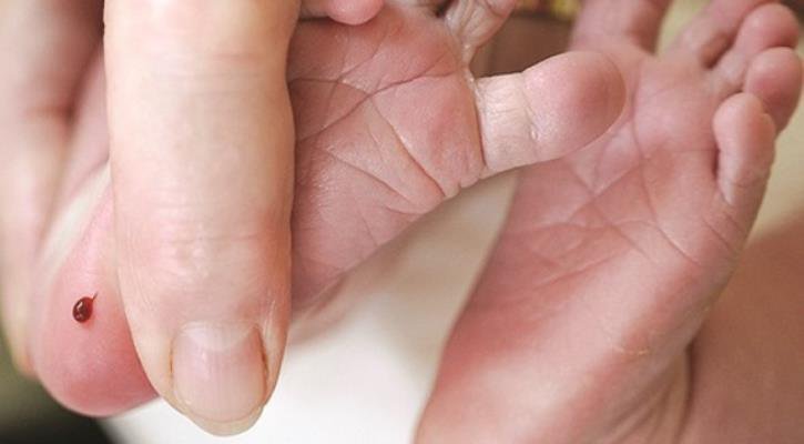 Chẩn đoán và điều trị thiểu năng tuyến giáp ở trẻ sơ sinh Chẩn đoán và điều trị thiểu năng tuyến giáp ở trẻ sơ sinh
