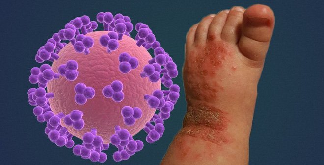 Dấu hiệu hiv ở trẻ em