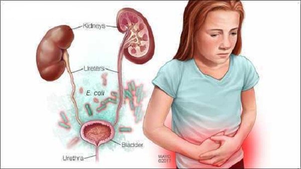 Nguyên nhân, dấu hiệu trẻ bị viêm đường tiết niệu Nguyên nhân, dấu hiệu trẻ bị viêm đường tiết niệu