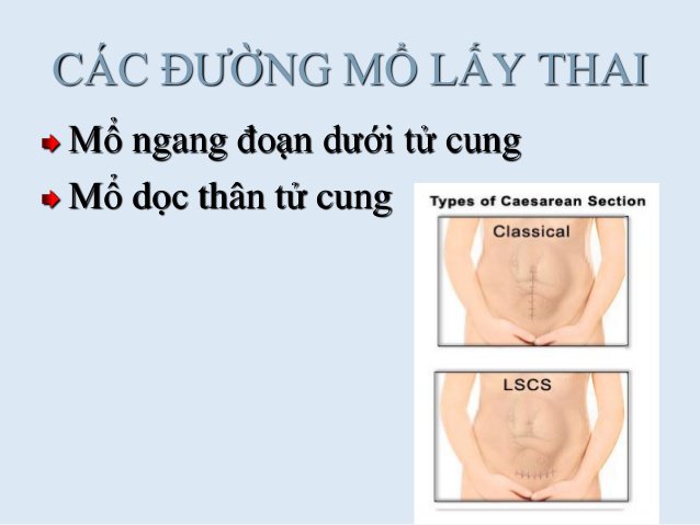 Vỡ tử cung trong thai kỳ: Nguyên nhân, dấu hiệu nhận biết Vỡ tử cung trong thai kỳ: Nguyên nhân, dấu hiệu nhận biết