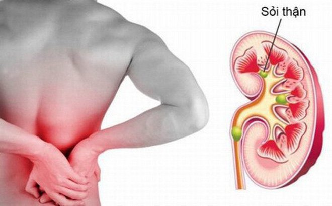 Nguyên nhân và triệu chứng viêm kẽ thận mạn Nguyên nhân và triệu chứng viêm kẽ thận mạn