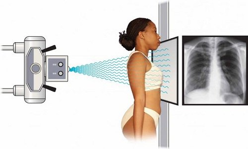 Bệnh tim thiếu máu cục bộ mạn tính: Những điều cần biết Bệnh tim thiếu máu cục bộ mạn tính: Những điều cần biết