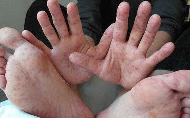 Tìm hiểu về EV71 - Tác nhân gây viêm não, tay chân miệng Tìm hiểu về EV71 - Tác nhân gây viêm não, tay chân miệng