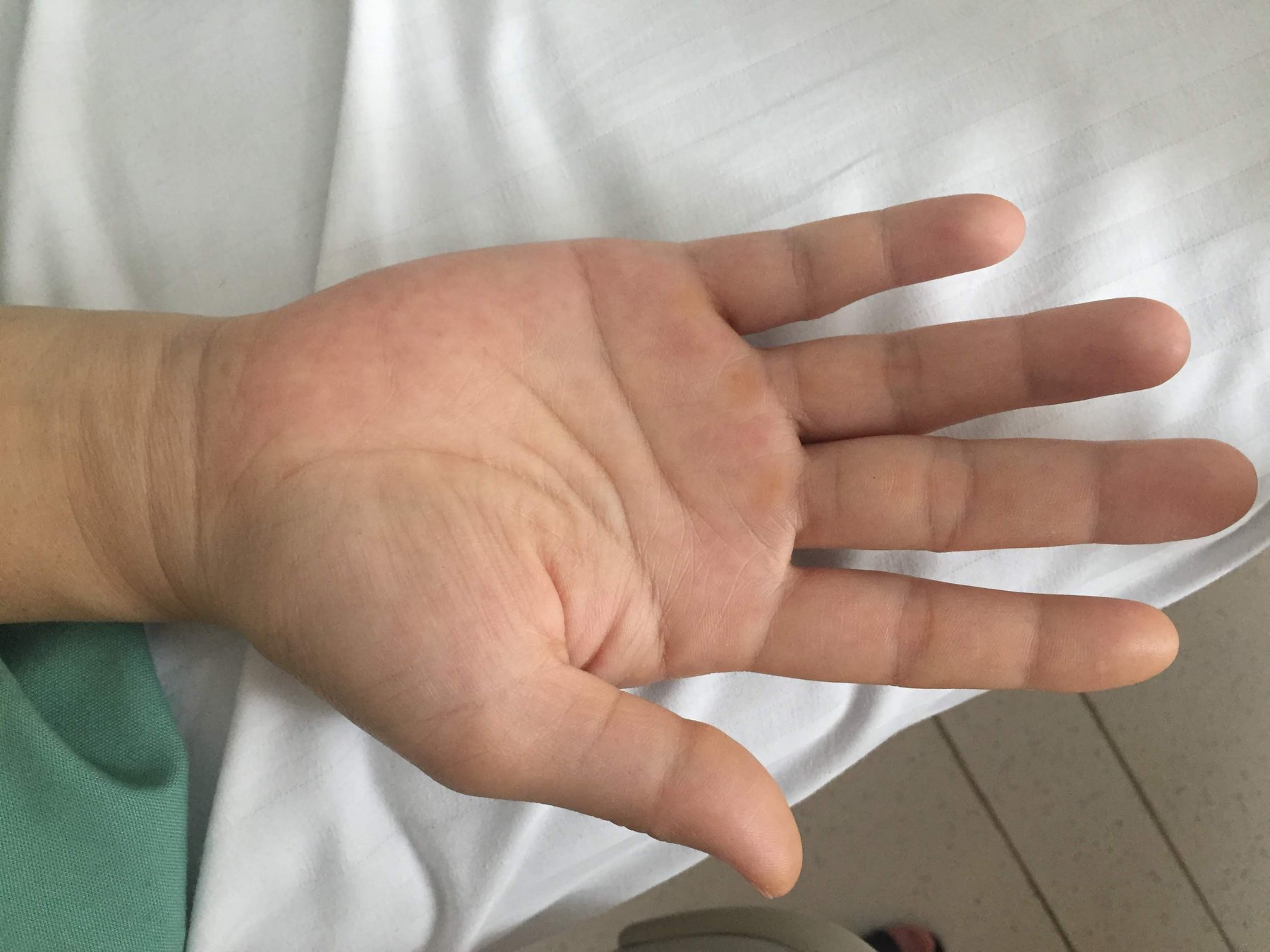 Tai biến gây mê: Vì sao bệnh nhân hạ thân nhiệt trong mổ? Tai biến gây mê: Vì sao bệnh nhân hạ thân nhiệt trong mổ?