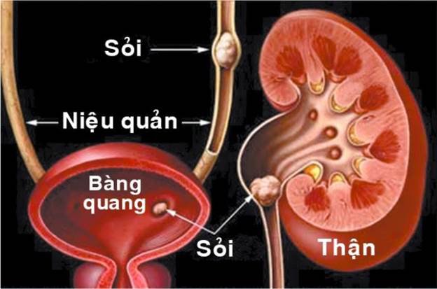 sỏi thận rơi xuống bàng quang-1