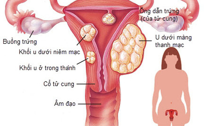 Nút mạch điều trị u xơ tử cung được áp dụng với trường hợp nào? Nút mạch điều trị u xơ tử cung được áp dụng với trường hợp nào?