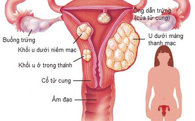 Nút mạch điều trị u xơ tử cung được áp dụng với trường hợp nào?