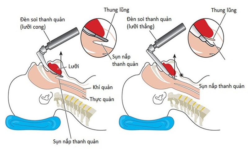 Đặt ống nội khí quản