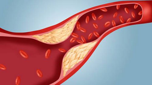 Phẫu thuật bắc cầu động mạch vành: Giải pháp điều trị bệnh mạch vành hiệu quả Phẫu thuật bắc cầu động mạch vành: Giải pháp điều trị bệnh mạch vành hiệu quả