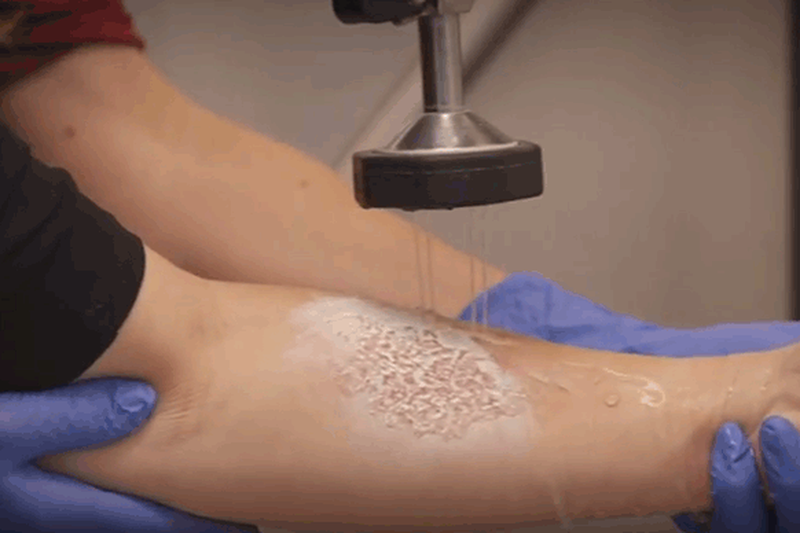 so-cuu-khi-bi-bong-hoa-chat-1