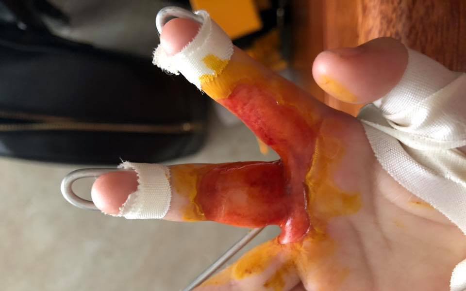 so-cuu-khi-bi-bong-dien-2