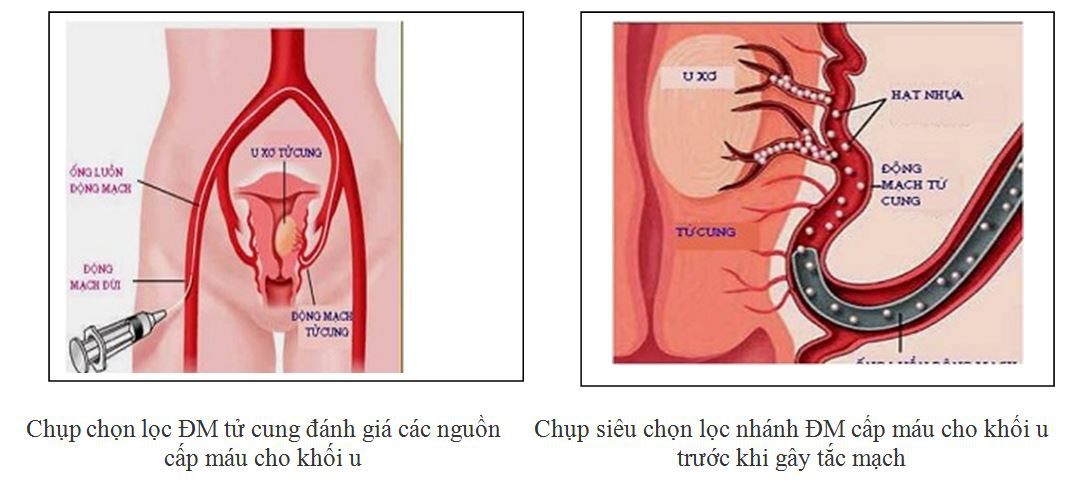 Nút mạch u xơ tử cung