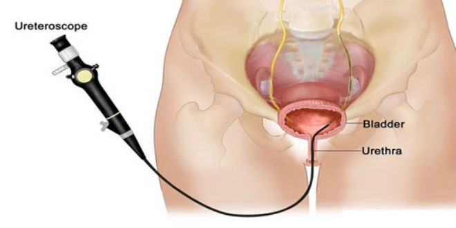 Các tác dụng phụ có thể gặp khi nội soi bàng quang Các tác dụng phụ có thể gặp khi nội soi bàng quang