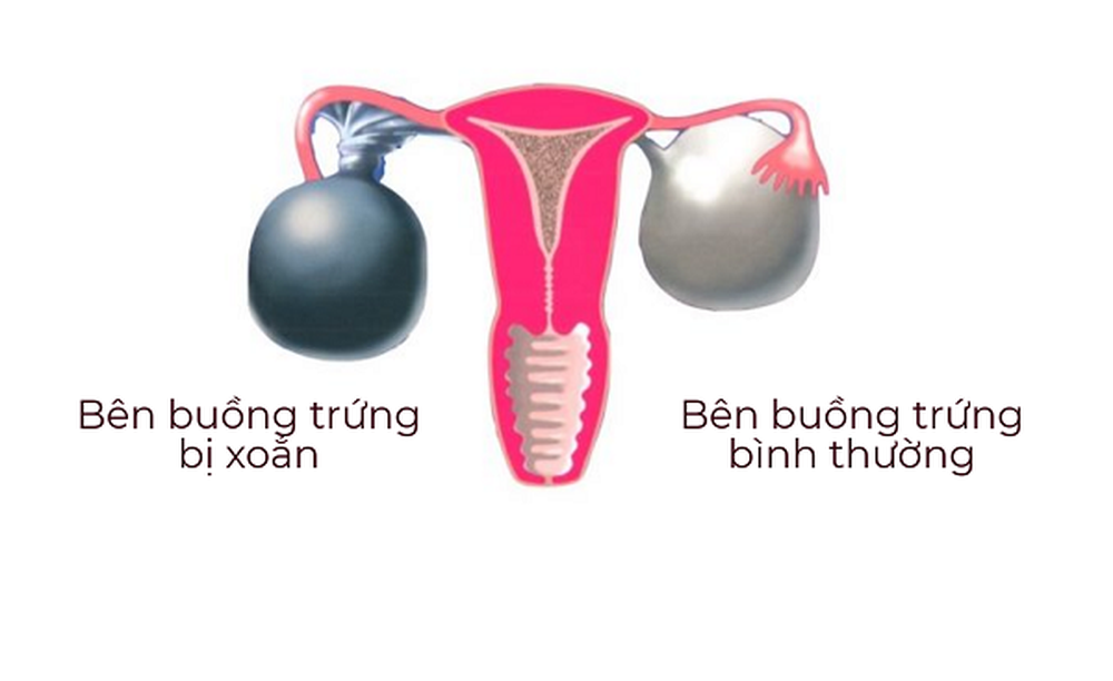 Đau tại buồng trứng