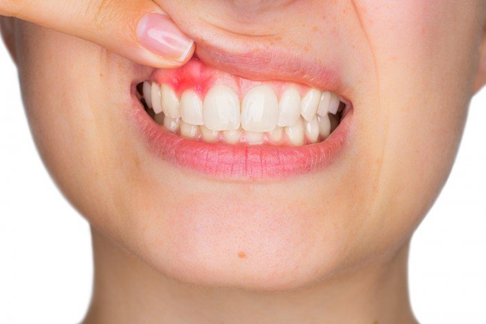 Làm thế nào để trị dứt điểm nhức răng sau sinh? Làm thế nào để trị dứt điểm nhức răng sau sinh?